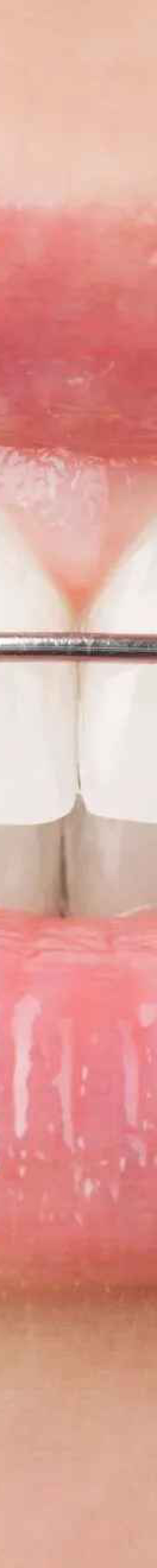 Removable orthodontics